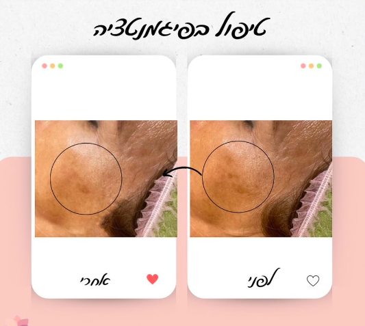 תוצאת טיפול 10